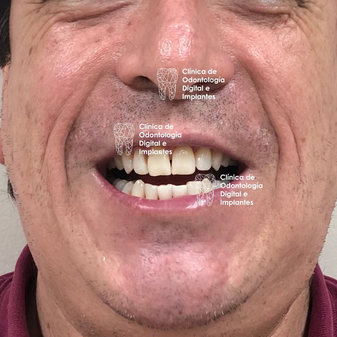 Después del tratamiento