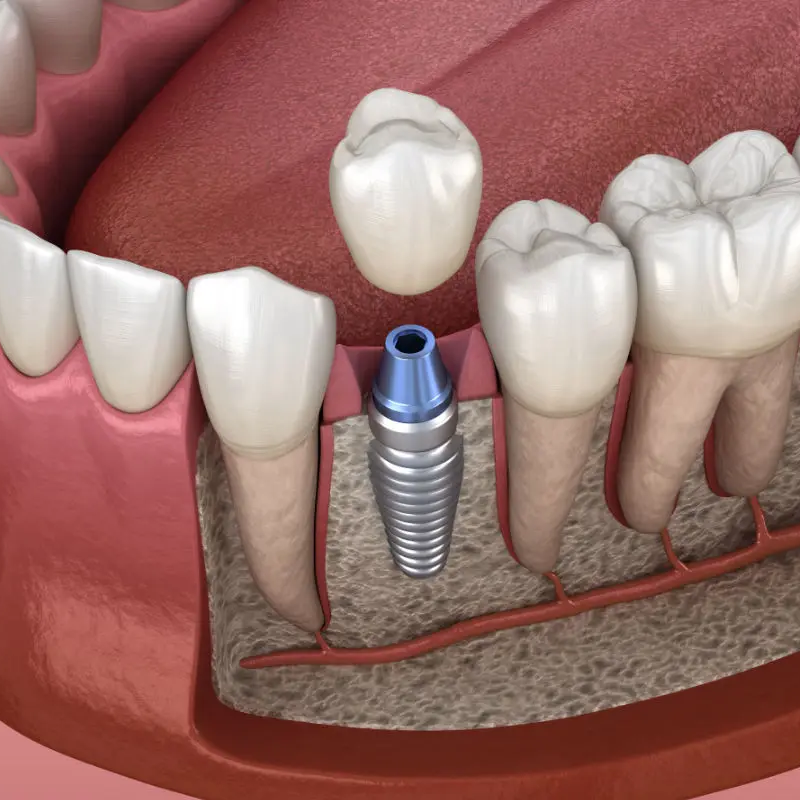Implantes Dentales