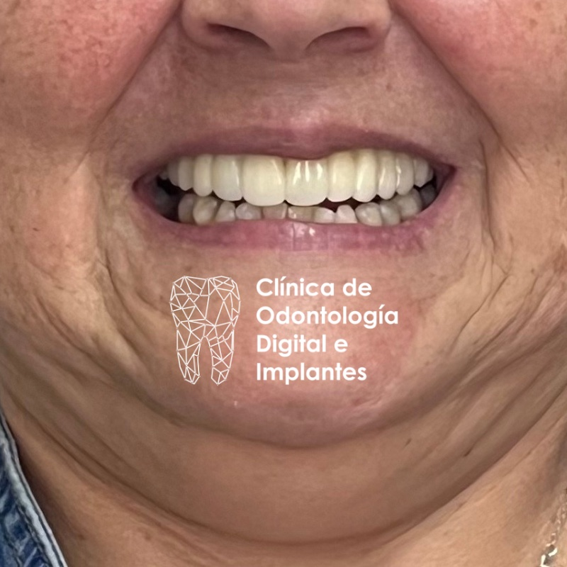 Después del tratamiento